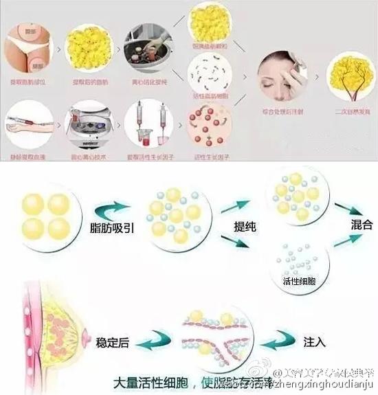 手术减肥 > 正文     自体脂肪从人体自身某些部位吸取多余的皮下脂肪